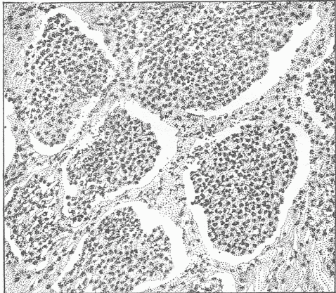 Fig. 15—A Section Of An Inflamed Lung Showing The Exudate Within The Air Spaces. Compare this with Fig 6. Fig 15 is from the human lung, in which the air spaces are much larger than in the mouse.