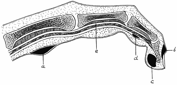 Fig. 9.—Diagram of various forms of Whitlow.
a = Purulent blister.
b = Suppuration at nail fold.
c = Subcutaneous whitlow.
d = Whitlow in sheath of flexor tendon (e).