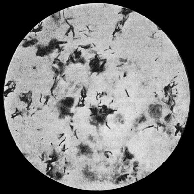 Fig. 33.—Tubercle Bacilli in caseous material × 1000 diam. Z. Neilsen stain.