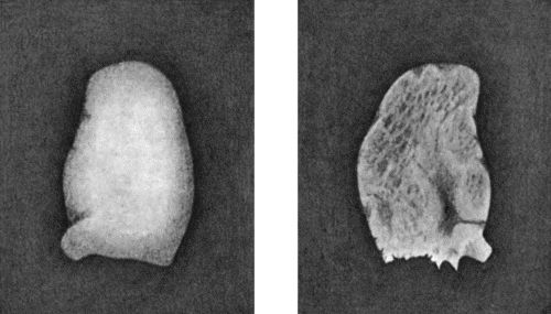 Fig. 167.—Loose Body from Knee-joint of man æt. 25. Natural size. a=Convex surface. b = Concave surface.