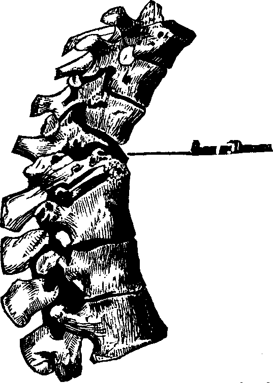 Illustration:
Fig. 1.  The above portion of the spinal column shows the manner of the
breaking down of the vertebræ from caries, and the absorption of
their bony structure.