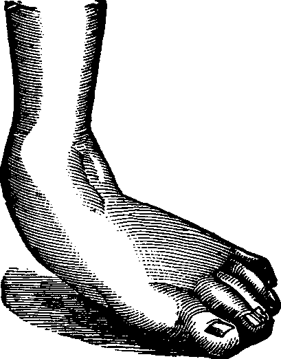 Illustration:
Fig. 12. Talipes Valgus.