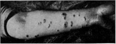 Large-pustular Syphiloderm