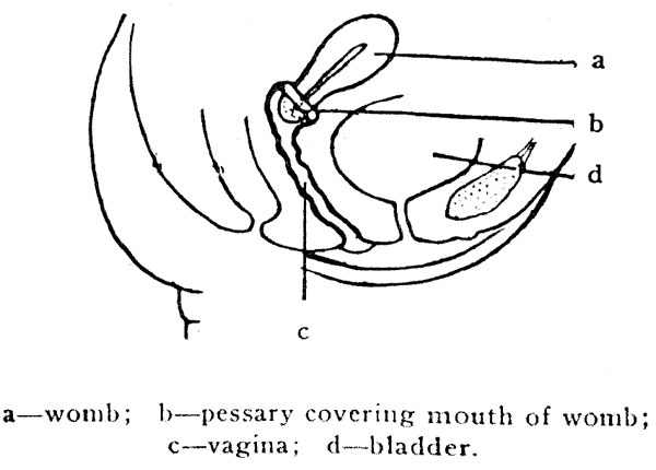 a—womb; b—pessary covering mouth of womb; c—vagina;
d—bladder.