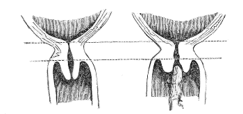 Neck of
the Womb